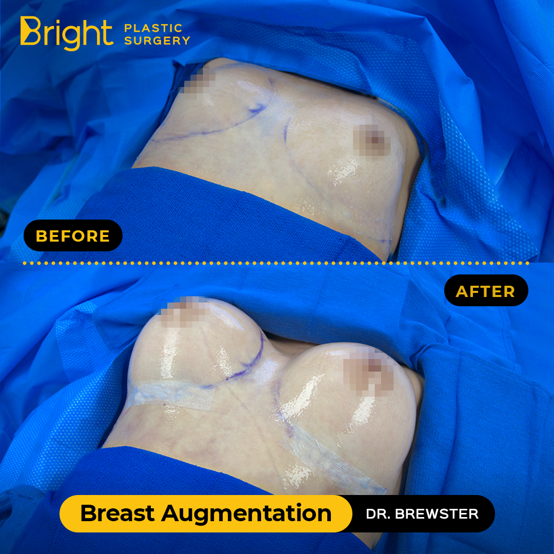 Breast Augmentation Surgery Before and After