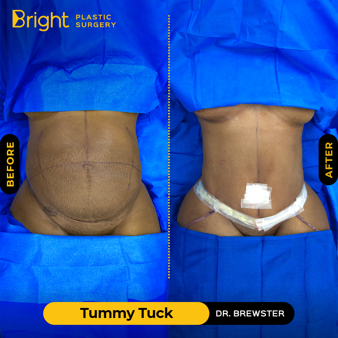 Tummy Tuck Before & After Photos - Law Plastic Surgery