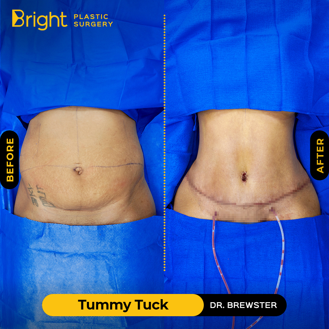 Antes y después de Abdominoplastia - Bright Plastic Surgery