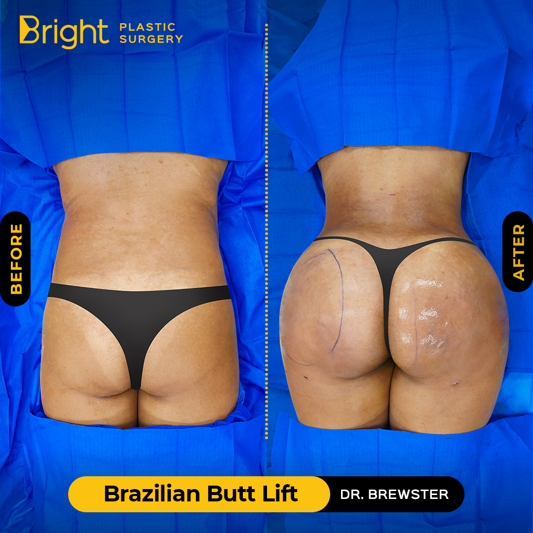 Covid-19 and Brazilian Butt Lift Procedure - Dr. Cat Begovic